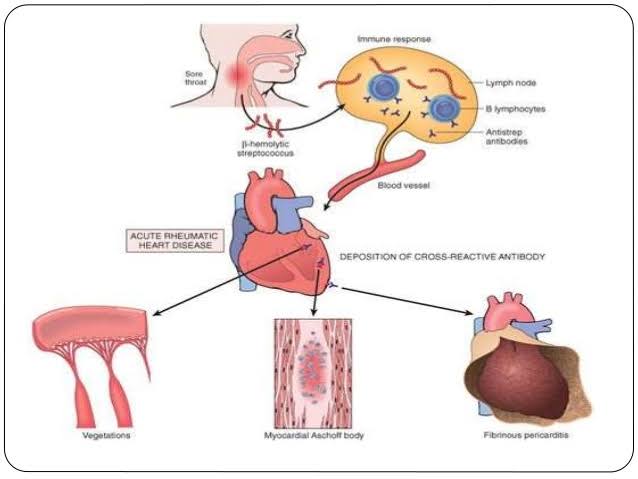 rheumatic heart disease essay